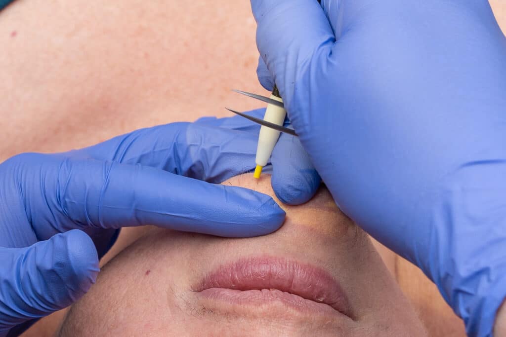 Close-up of a clinician wearing blue gloves using a precision skin treatment tool on the patient’s chin area, preparing to perform a cosmetic procedure.