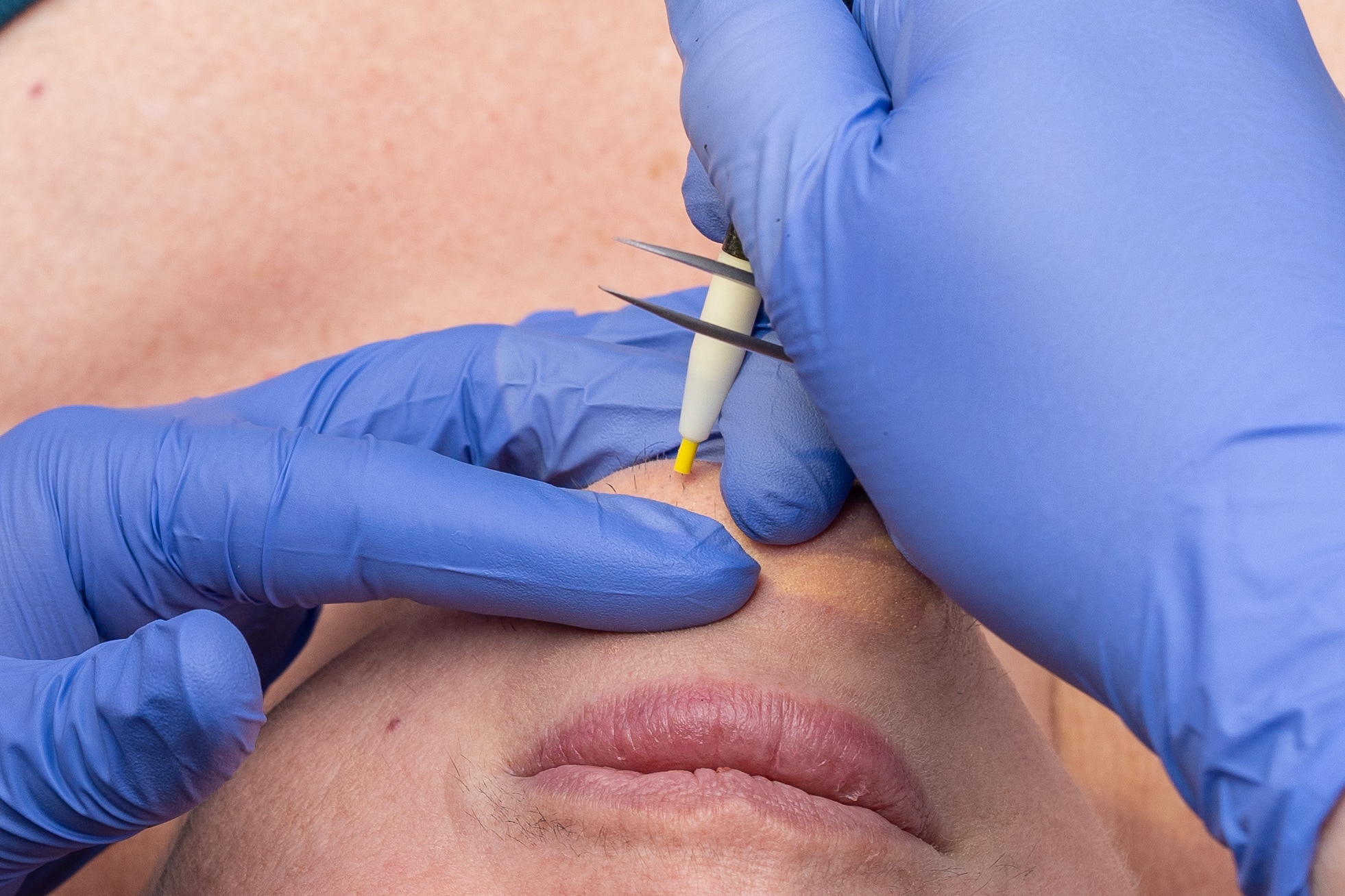 Close-up of a clinician wearing blue gloves using a precision skin treatment tool on the patient’s chin area, preparing to perform a cosmetic procedure.