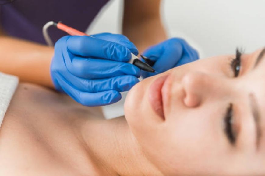 Close-up of a beauty clinician in blue gloves performing a facial treatment near a woman's lips.